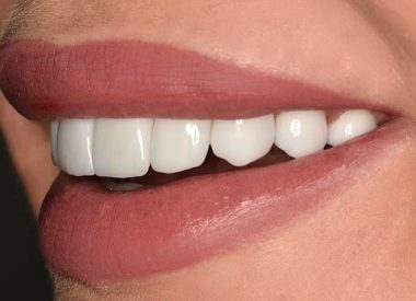 The patient lives abroad and requested that permanent veneers were made during one week. The veneers were made and fitted in the oral cavity within five working days. The patient was very pleased with the result.