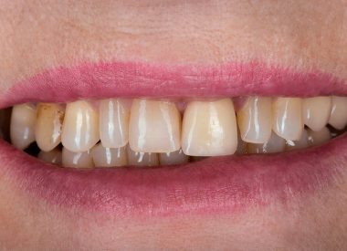 Пациентка обратилась в стоматологическую клинику с просьбой сделать красивые, белоснежные зубы. Проживает за рубежом. Мы располагали двумя неделями для реабилитации обеих челюстей.