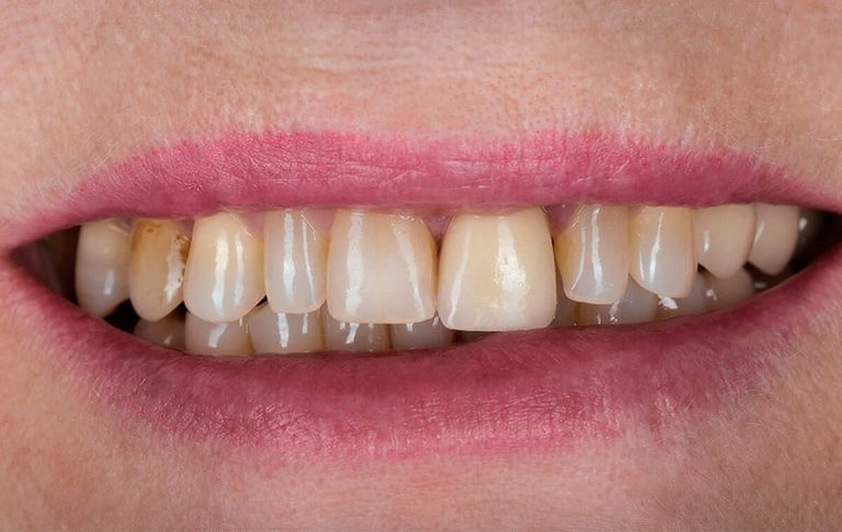 Пацієнтка звернулась в стоматологічну клініку з проханням зробити красиві білосніжні зуби. Проживає за кордоном. Ми мали у своєму розпорядженні два тижні для реабілітації обох щелеп.
