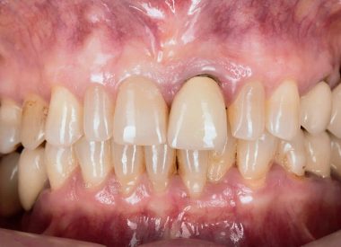 After the full-mouth debridement, the tooth shape and color were approved, and then the impressions were taken to manufacture the full-contour zirconia crown for both jaws.