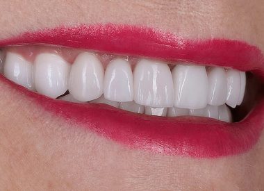 В течении 8-ми рабочих дней были изготовлены зубные коронки, которые после примерки и утверждения пациенткой, были фиксированы в полости рта.