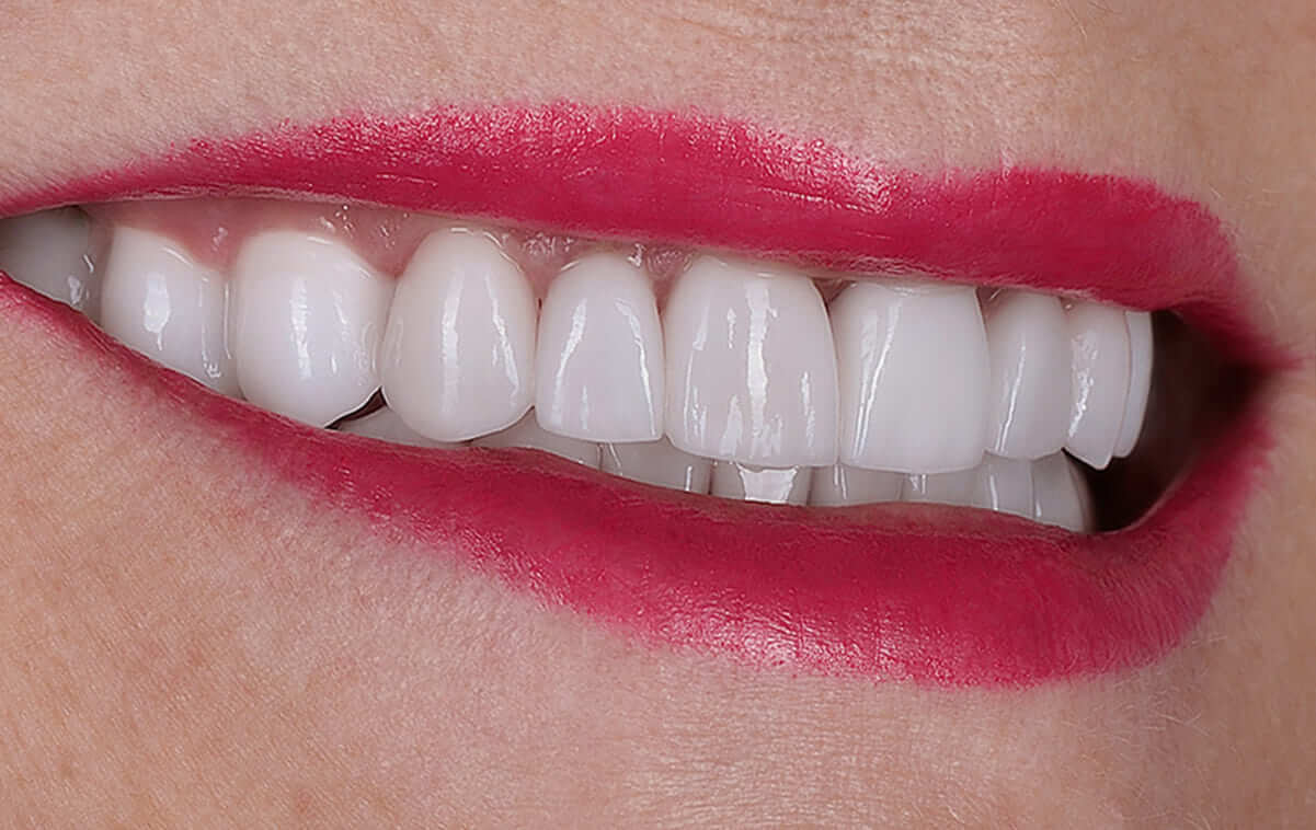 В течении 8-ми рабочих дней были изготовлены зубные коронки, которые после примерки и утверждения пациенткой, были фиксированы в полости рта.