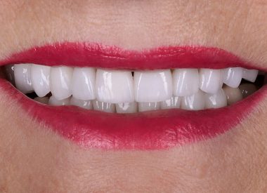Впродовж восьми робочих днів були виготовлені зубні коронки, які після примірки і затвердження пацієнткою були фіксовані в порожнині рота.