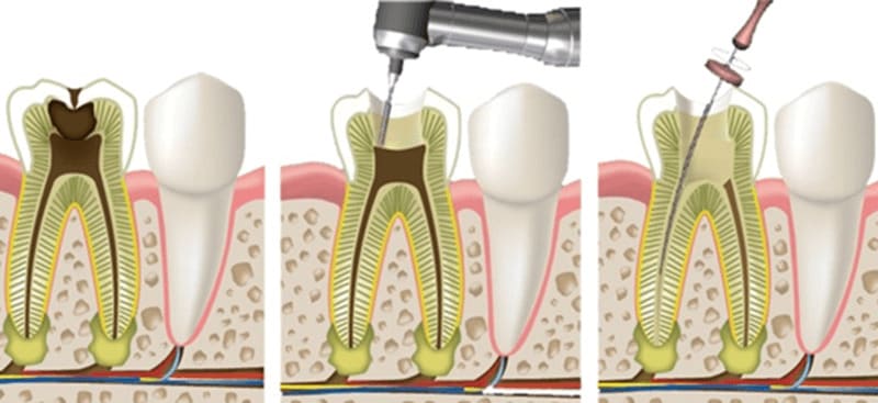 How dentists remove tooth nerves