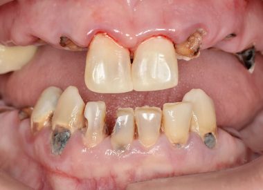 Пациентка из США обратилась к нам в клинику за стоматологической помощью. Она испытывала на протяжении жизни страх лечить зубы. Объективно большинство зубов было разрушено ниже десневого края, оставшиеся зубы были поражены кариесом.