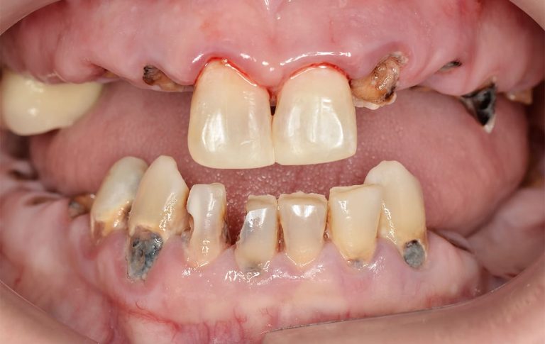Пациентка из США обратилась к нам в клинику за стоматологической помощью. Она испытывала на протяжении жизни страх лечить зубы. Объективно большинство зубов было разрушено ниже десневого края, оставшиеся зубы были поражены кариесом.