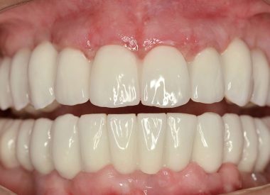 Через 4 місяці були зняті відбитки і виготовлені повно анатомічні цирконієві коронки Prettau (Zirkonzahn) на обидві щелепи, які кріпились до зубних імплантатів за допомогою гвинтової фіксації.