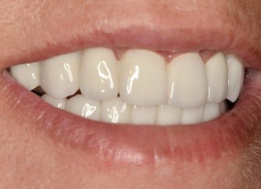 4 місяці по тому повторний візит до стоматолога для контрольного огляду і деконтамінації (гігієнічна процедура) показав стабільний результат.