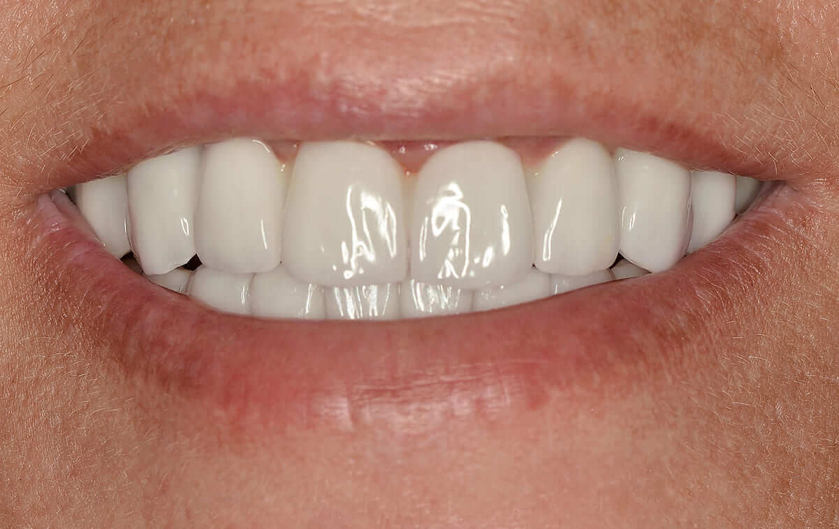Implant treatment to a patient with significant tooth loss due to severe caries