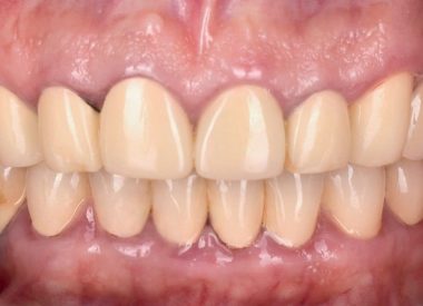 Більшість зубів під коронками мали ускладнений карієс і були непридатні для перепротезування.