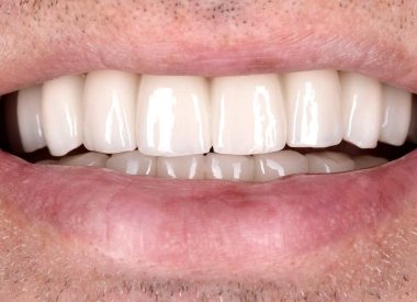 Пациенту было предложено удаление всех зубов на верхней челюсти с одномометной имплантацией шестью имплантатами и немедленной нагрузкой временными коронками.