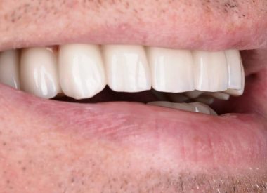 Four months later, screw-retained zirconium crowns reinforced with a titanium base were manufactured. The patient was completely satisfied with the result.