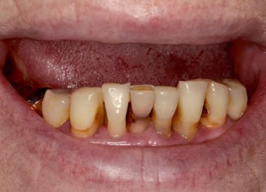 The patient complained of partial tooth loss and the remaining severely decayed teeth. Frontal teeth on the upper jaw decayed to the gingival margin due to complicated caries.