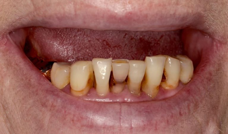 Пацієнтка звернулась зі скаргами на часткову втрату зубів і наявність сильно зруйнованих зубів, що залишились. На верхній щелепі через ускладнений карієс фронтальні зуби були зруйновані до рівня ясенного краю.