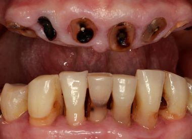 Мы предложили удалить все зубы, установить по четыре имплантата на каждую челюсть и изготовить прикручиваемые металлокомпозитные реставрации.