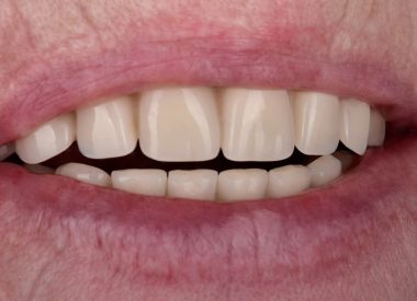 Ортопедичні конструкції були фіксовані через тиждень після видалення зубів і одномоментної імплантації. Отриманий результат повністю задовольнив побажання пацієнта.
