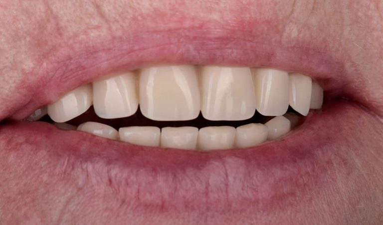 Implant rehabilitation of a patient according to the All-on-4 protocol