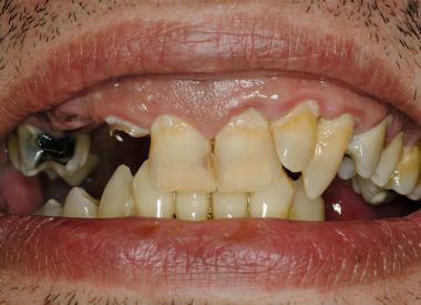 Пациент обратился в стоматологическую клинику с просьбой улучшить внешний вид зубов и получить красивую "белоснежную" улыбку.