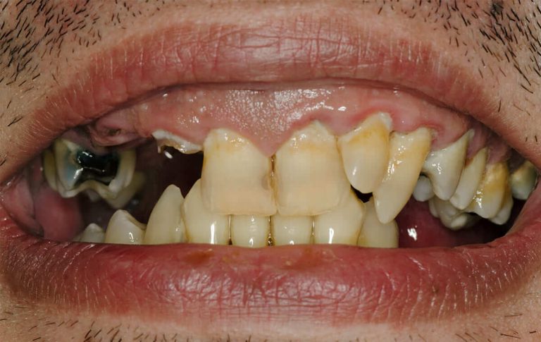 Implantological treatment of a patient with extensive tooth decay and deep traumatic overbite
