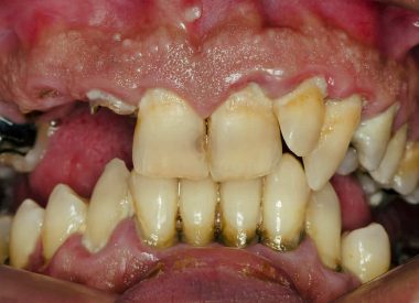 A physical examination revealed a large number of teeth affected by noticeable and extensive tooth decay, generalized periodontitis, poor hygiene, deep bite, retrusive profile, and traumatic occlusion.