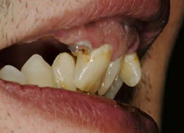 The dentists set the task of changing the dental bite, shape, color, and dentition.It was also necessary to determine which teeth will be removed. The patient refused from orthodontic treatment. He lives in Italy and could visit the clinic regularly.