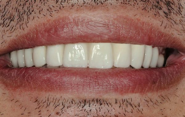 Implantological treatment of a patient with extensive tooth decay and deep traumatic overbite