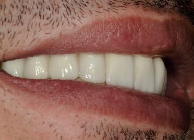 Four months later, the patient had his dental impressions retaken and zirconium screw-retained permanent crowns were manufactured.