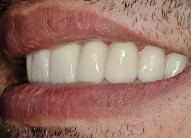 The patient was satisfied with the aesthetic and functional outcome of his implant treatment.