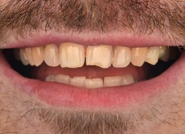 The patient contacted us to restore the anatomy of his damaged teeth using ceramic veneers and crowns.