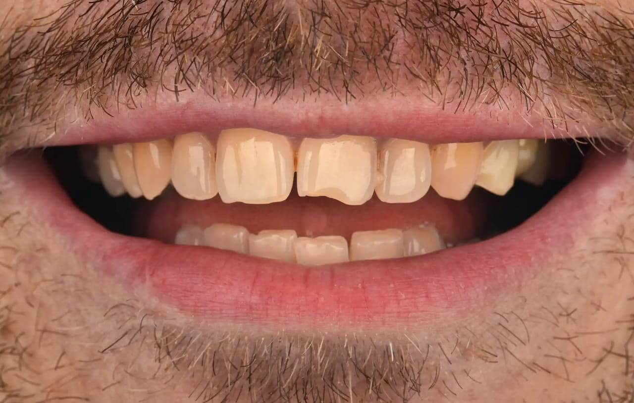 Пациент  обратился с просьбой восстановить анатомию своих разрушенных зубов при помощи керамических виниров и коронок.