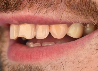 Для Пациента было очень важным что б новые керамические реставрации не отличались цветом от натуральных зубов.