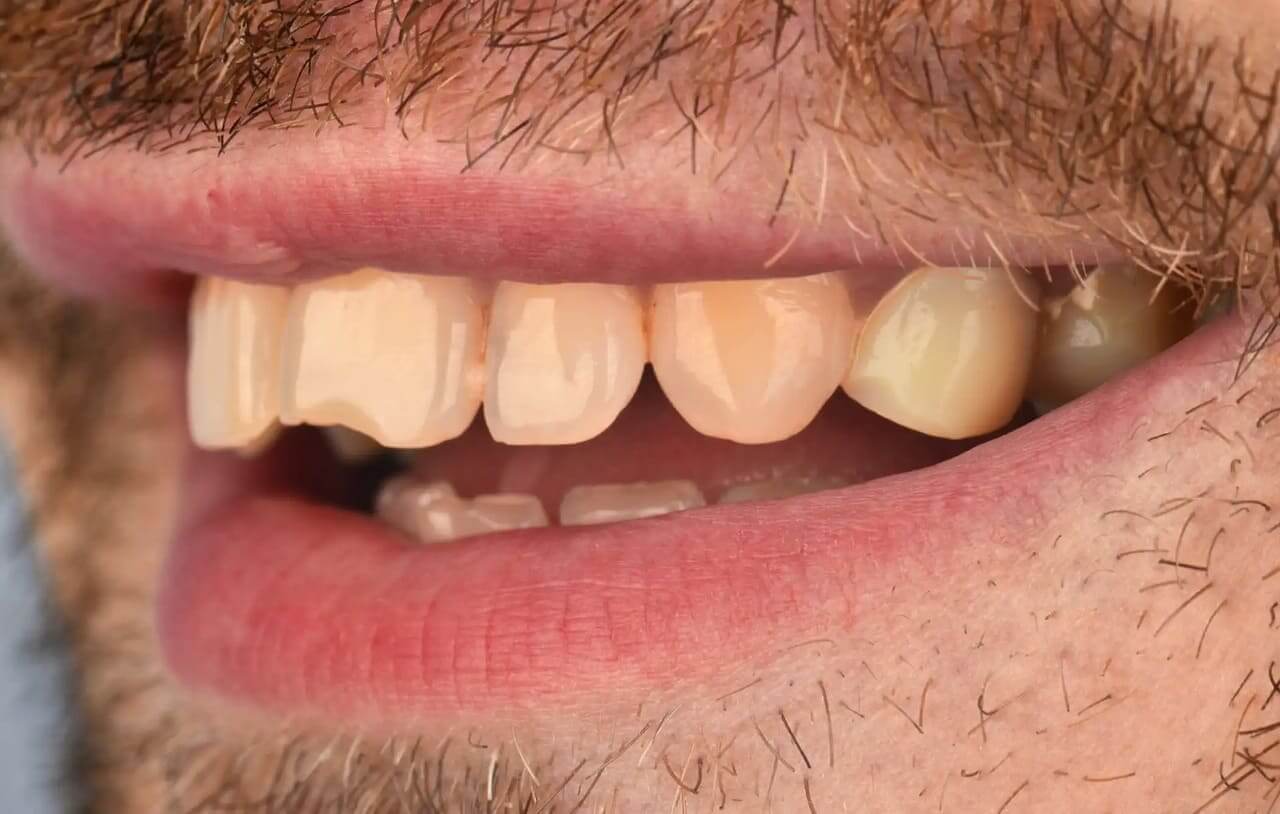 Для Пациента было очень важным что б новые керамические реставрации не отличались цветом от натуральных зубов.
