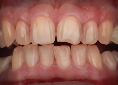 The patient had multiple chipped teeth as a result of restoration with photopolymer restorations.