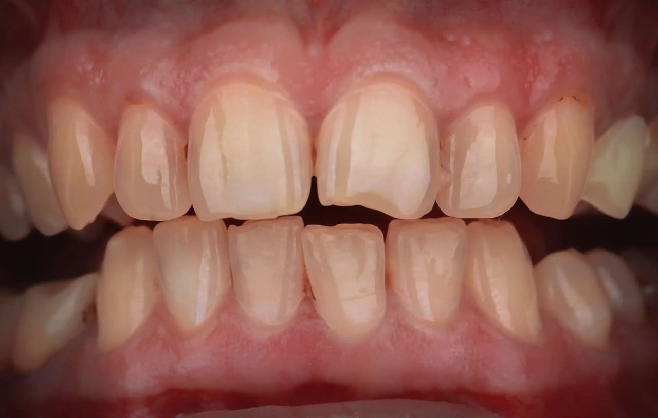 The patient had multiple chipped teeth as a result of restoration with photopolymer restorations.
