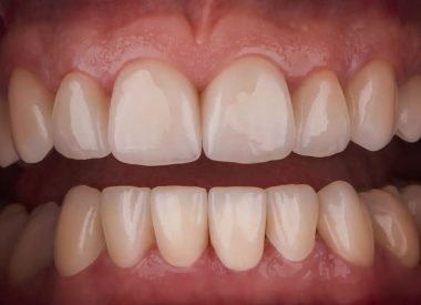 Ceramic veneers and crowns were made in the frontal area of both jaws whereas the premolars and molars were covered with zirconium crowns.