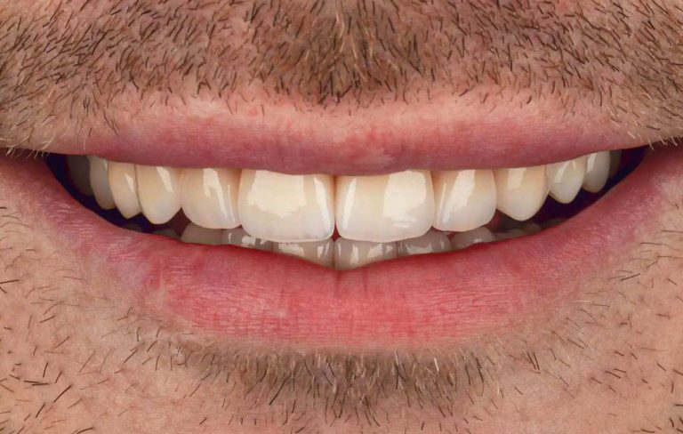 Ceramic restorations in A2 color are the ideal solution for natural restoration of the own teeth