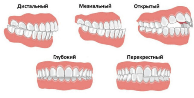 Виды неправильного прикуса