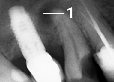 The clinic was contacted by a patient who had a long-term dental issue. X-ray analysis showed the presence of a long-standing inflammation at the apex of a root, which appeared in the picture as a dark spot with a clear outline. Previously, this issue would have been resolved by a removal of the tooth in...