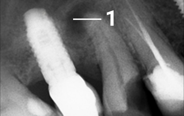 В клініку звернувся пацієнт з приводу тривалого болю у зубі. Рентгенологічний аналіз показав наявність на верхівці кореня застарілого запального процесу, який проявляється на знімку у вигляді темної плями з чіткими контурами, що, як вважалося багато років тому, є показанням до видалення. 1 – вогнище деструкції з чіткими контурами