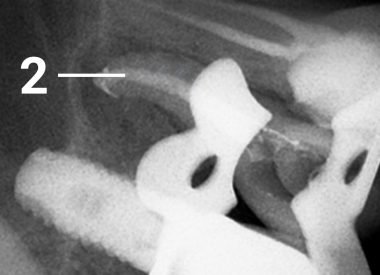 Endodontic treatment was performed which included an extension and thorough disinfection of the root canal. The canal was later sealed with a filling. 2 – the filling material in the channel