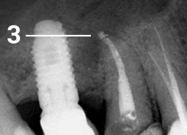 Повторное обследование через 4 месяца показало, что костная ткань в области верхушки зуба полностью восстановилась и пациента этот зуб больше не беспокоит. 3 – спустя 4 месяца костная ткань восстановилась (исчезло темное пятно с четкими контурами вокруг корня)