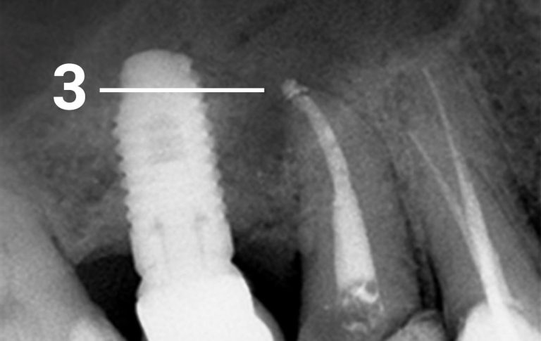 Extensive endodontic treatment of an inflammation that prevented a tooth extraction