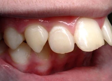 Діагноз: дистальний глибокий прикус, сагіттальна щілина 14 мм, звуження зубних рядів бічних ділянок верхньої та нижньої щелеп, скупченість.