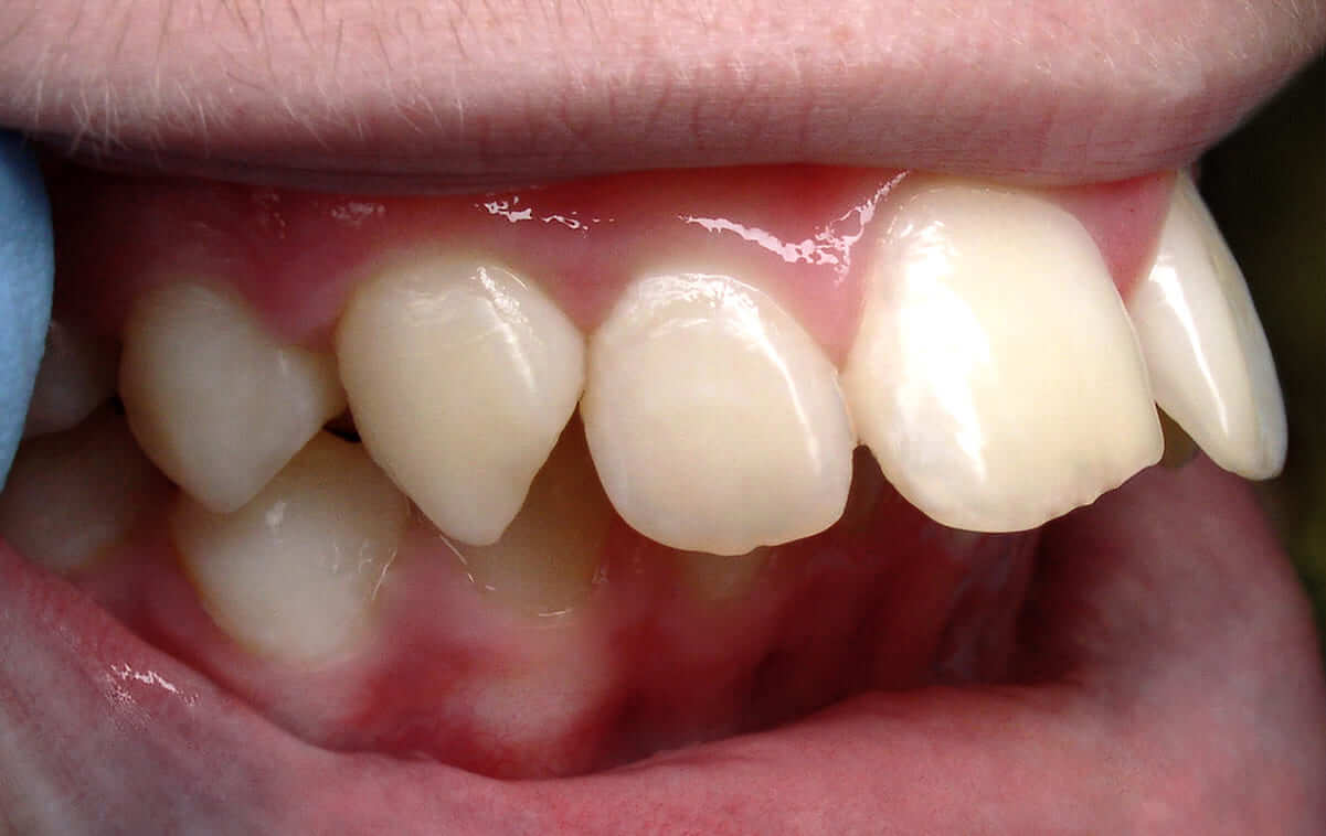 Діагноз: дистальний глибокий прикус, сагіттальна щілина 14 мм, звуження зубних рядів бічних ділянок верхньої та нижньої щелеп, скупченість.
