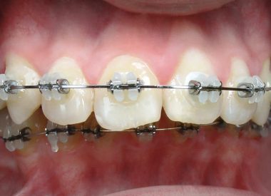 Один з етапів лікування. Зміна форми зубних дуг, вирівнювання зубних рядів, сагіттальна щілина зменшилася на 5 мм.