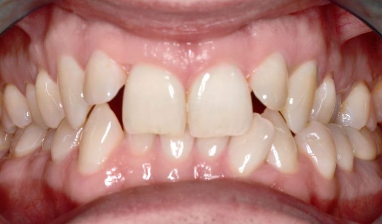 Two stage treatment of distal occlusion with help of orthodontic appliance “Herix” and self-ligating braces for adult