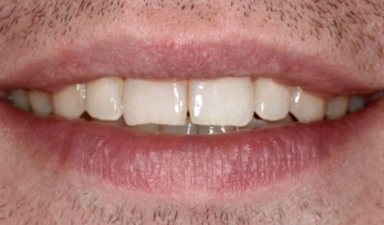 Two stage treatment of distal occlusion with help of orthodontic appliance “Herix” and self-ligating braces for adult