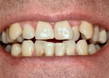 The patient was concerned about the aesthetic appearance of his teeth. Diagnosis: anterior crossbite (negative over-jet), teeth crowding, pathological abrasion, gum recession.