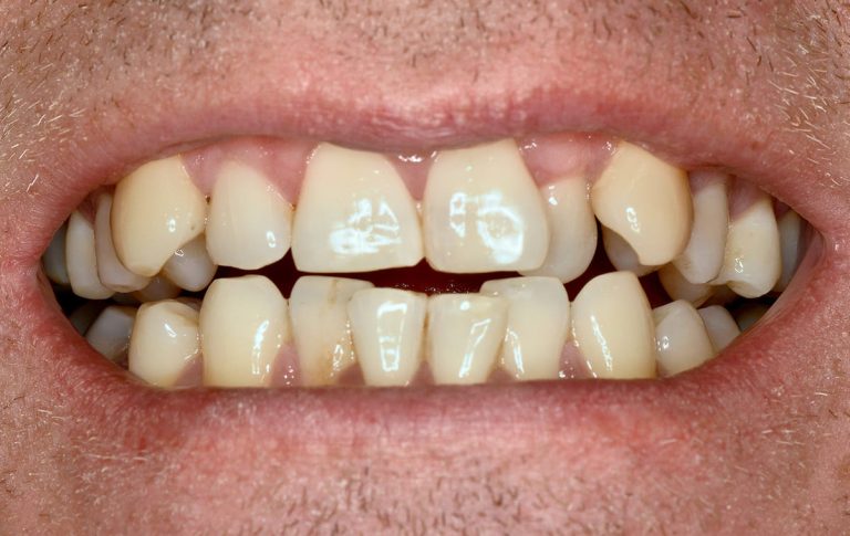 The patient was concerned about the aesthetic appearance of his teeth. Diagnosis: anterior crossbite (negative over-jet), teeth crowding, pathological abrasion, gum recession.