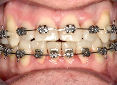 During the last phase of orthodontic treatment, the patient had an implant placed in the area of the 36th tooth. After removing the braces, a zirconia crown was placed in the area of the 36th tooth implant. A metal retainer was fixed on the lower jaw.